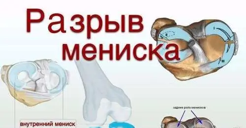 Повреждение мениска